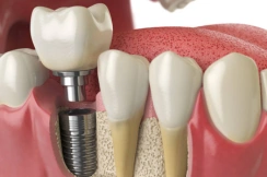 Dental implant